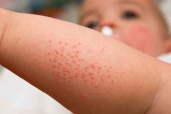 Cảnh báo bệnh sốt phát ban dạng sởi gia tăng.