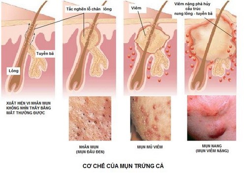 Ðiều cần lưu ý khi bị mụn trứng cá
