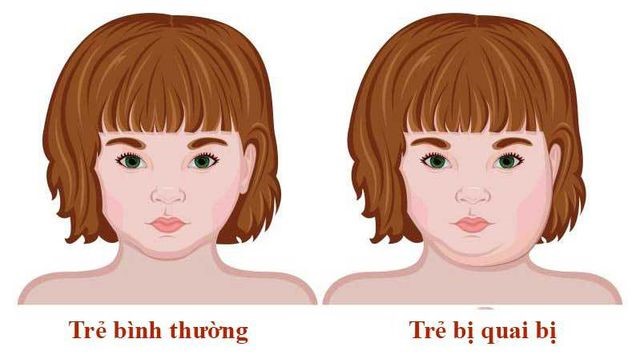7 dấu hiệu của bệnh quai bị