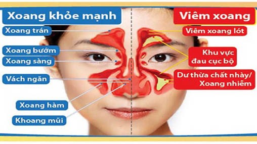 Viêm mũi xoang vào mùa lạnh, chữa như thế nào?