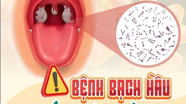 Bạch hầu: Nguyên nhân, triệu chứng, biến chứng và phòng ngừa bằng vắc-xin