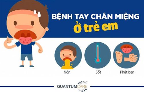 Bài tuyên truyền về bệnh “ tay- chân- miệng”